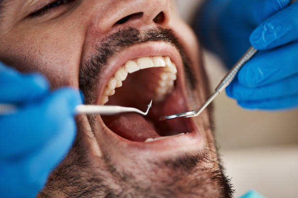 Best Emergency Wisdom Tooth Extraction in Christopher, IL
